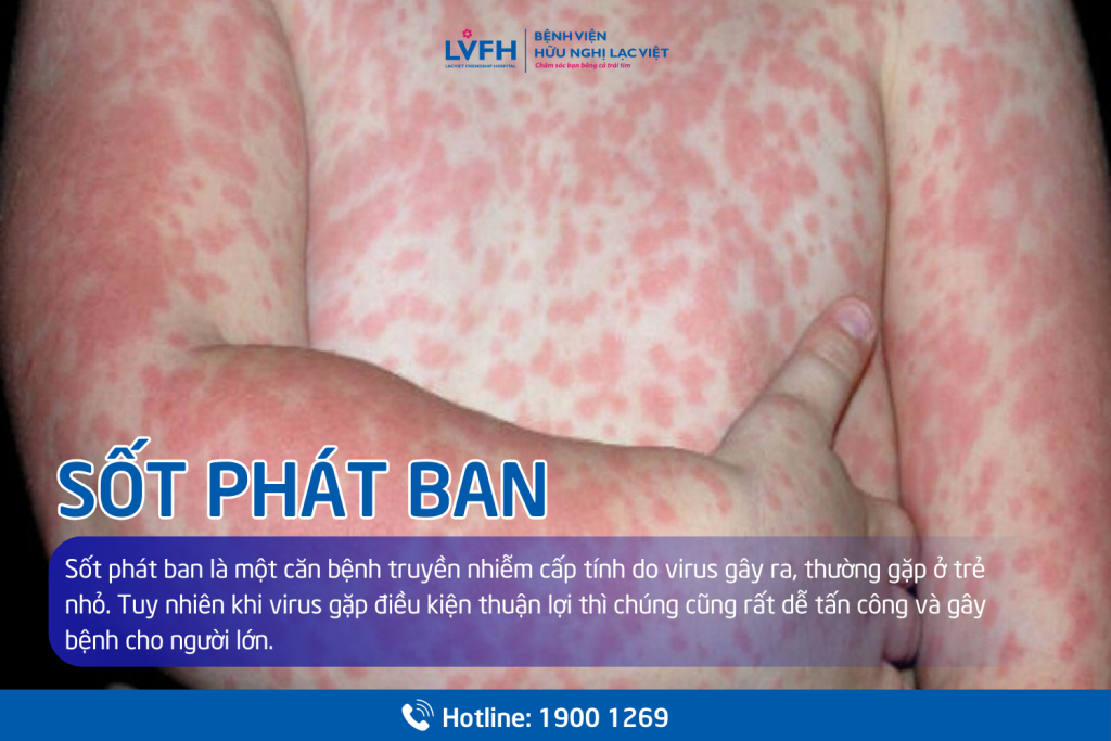 Sốt phát ban ở trẻ nhỏ và người lớn: Triệu chứng và cách điều trị