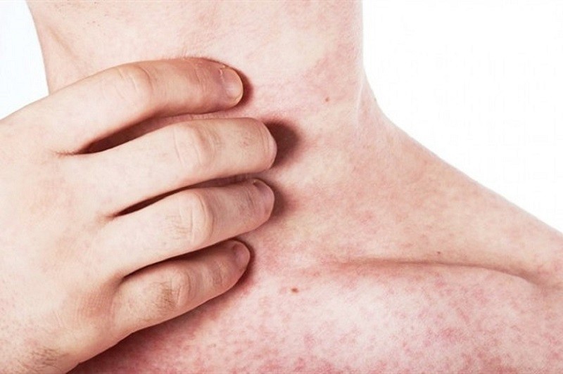 Sốt phát ban ở người lớn thường có thời gian ủ bệnh từ 1-2 tuần