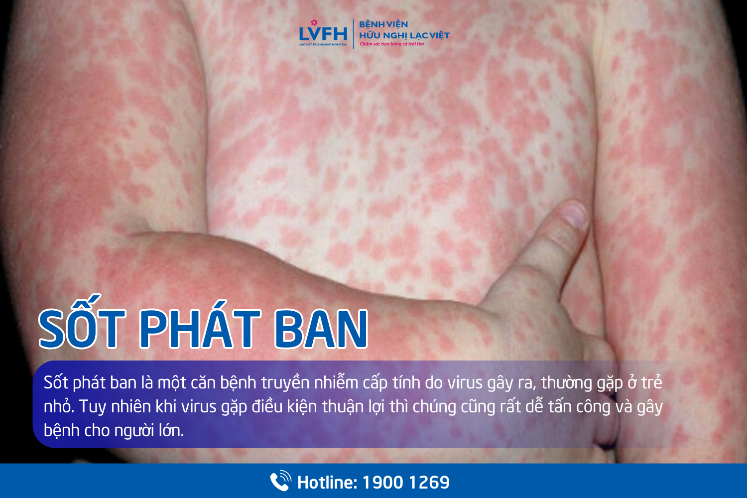 sot phat ban