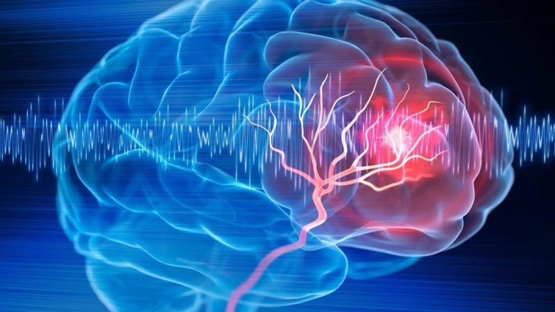 Đột quỵ: Tầm quan trọng trong phát hiện sớm, dấu hiệu và cách phòng tránh