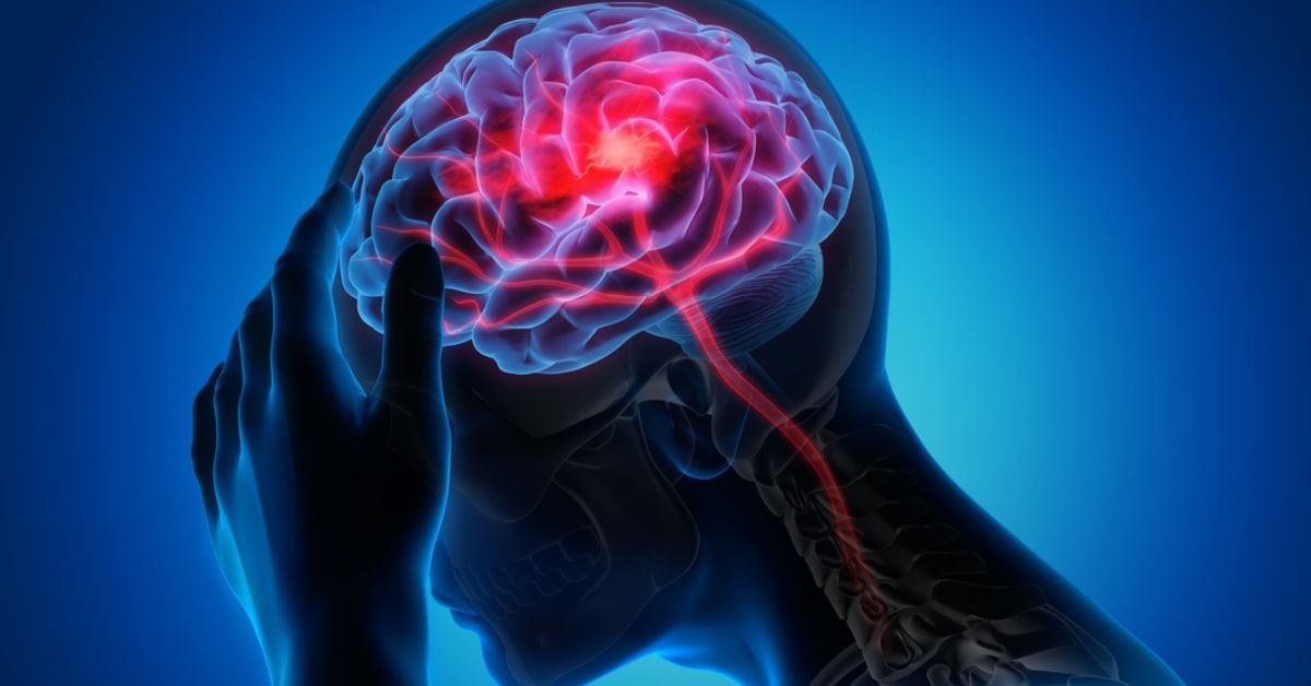 Phương pháp Tiêu sợi huyết trong điều trị đột quỵ nhồi máu não 3 Thời điểm vàng để điều trị bằng thuốc tiêu sợi huyết là trong 3 giờ đầu kể từ khi triệu chứng đầu tiên xuất hiện