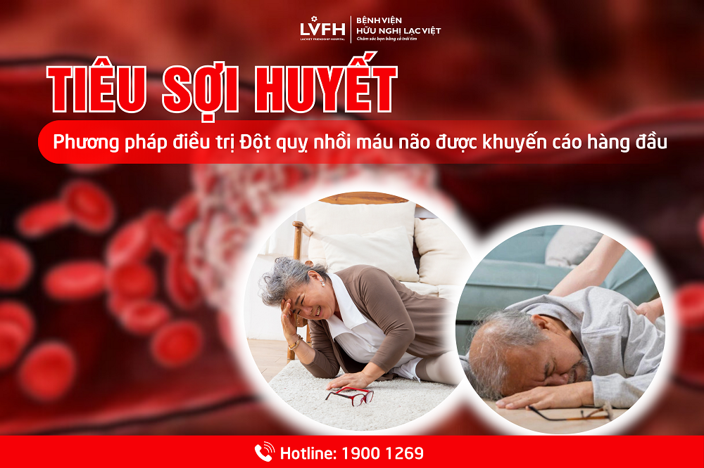 Phương pháp Tiêu sợi huyết trong điều trị đột quỵ nhồi máu não 1 Tiêu sợi huyết - Phương pháp điều trị Đột quỵ nhồi máu não được khuyến cáo hàng đầu