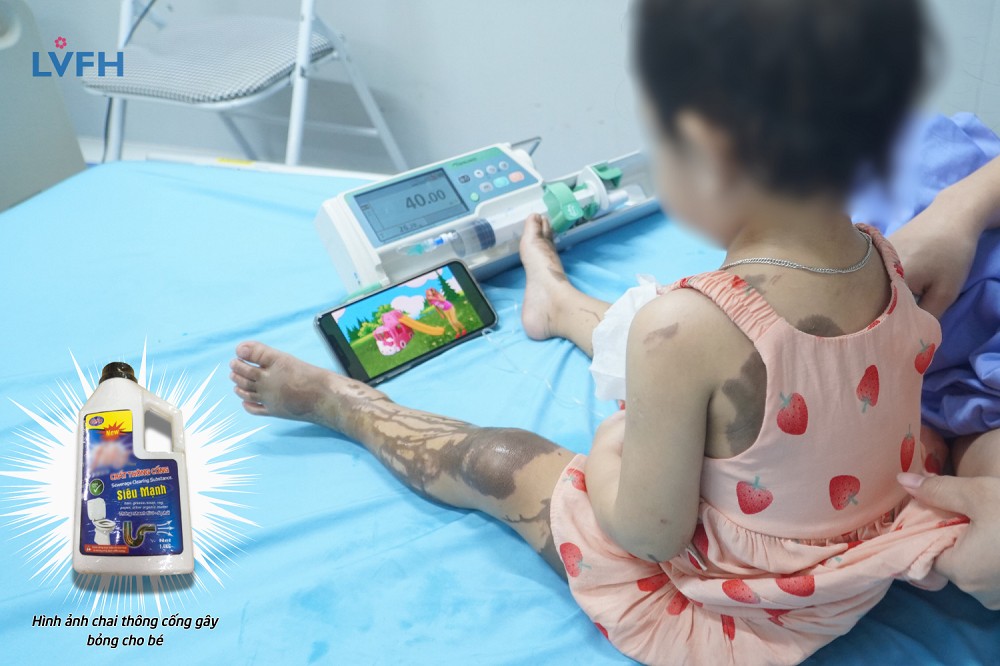 Nhiều trường hợp trẻ bị bỏng nghiêm trọng