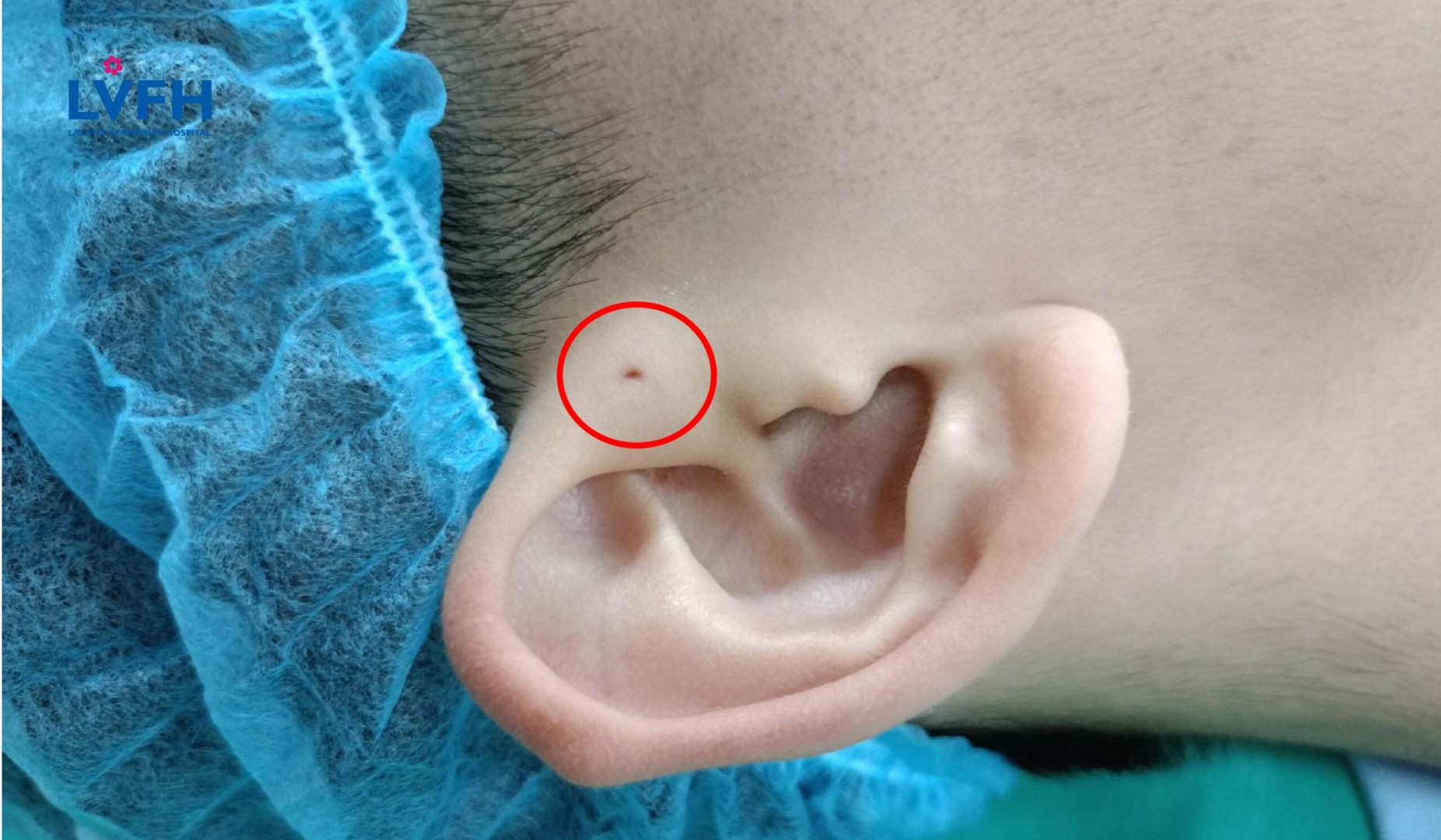 Bệnh nhi chuẩn bị được phẫu thuật Rò luân nhĩ tại Bệnh viện Lạc Việt