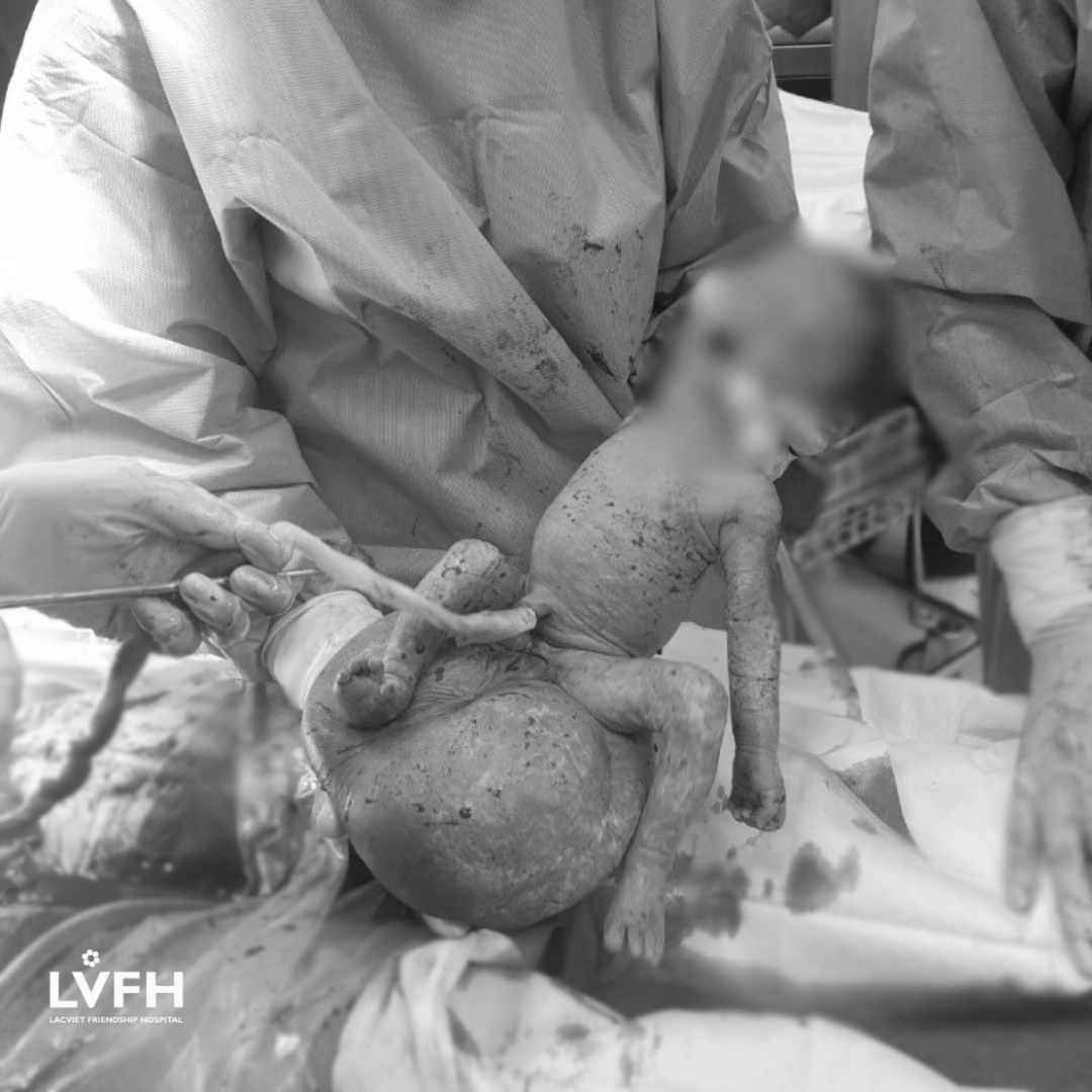 Bé sơ sinh chào đời với khối U quái “khổng lồ” vùng cùng cụt hiếm gặp 3 Hình ảnh khối u quái “khổng lồ” vùng cùng cụt của em bé khi chào đời