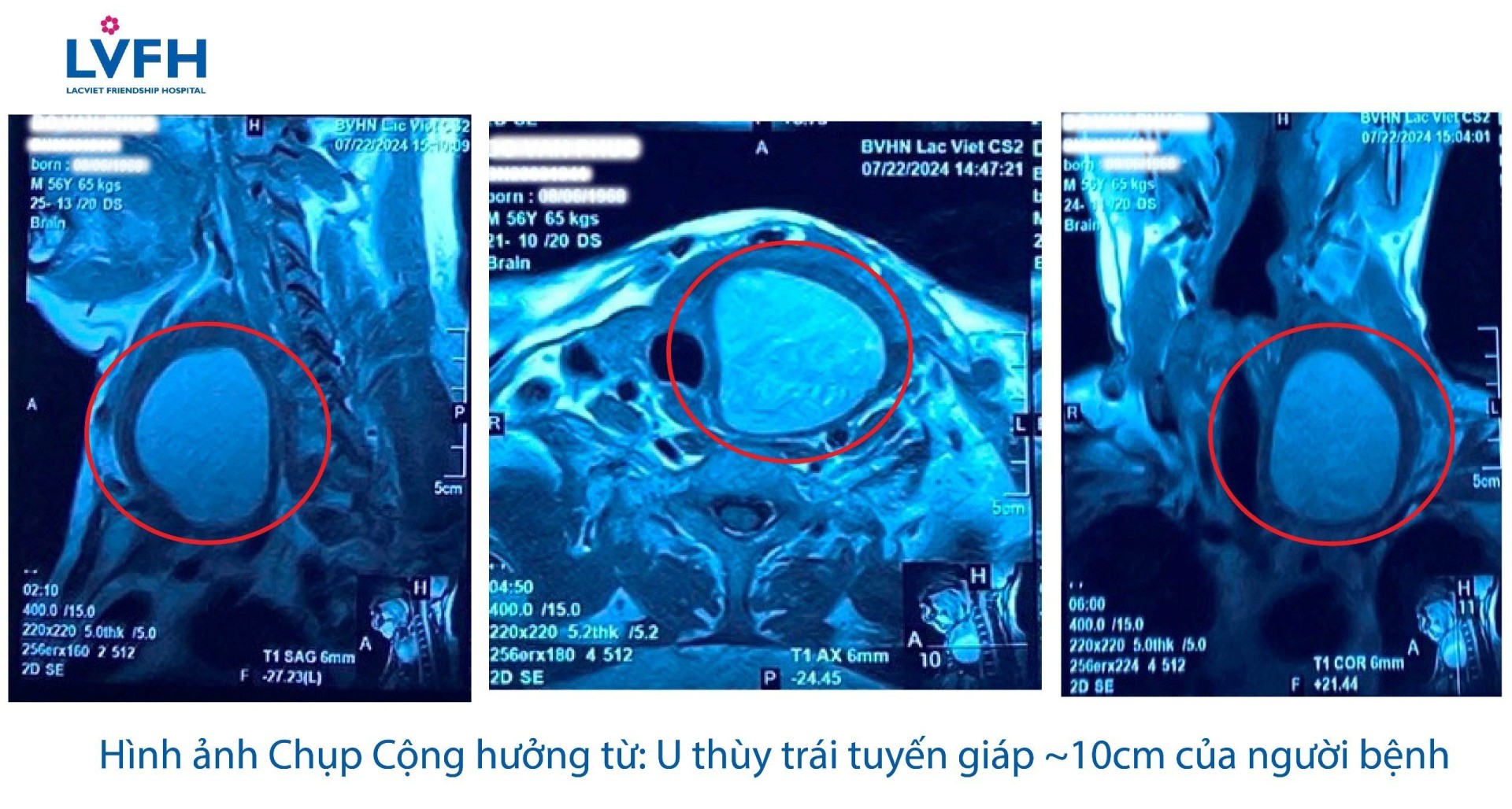 MRI u tuyen giap