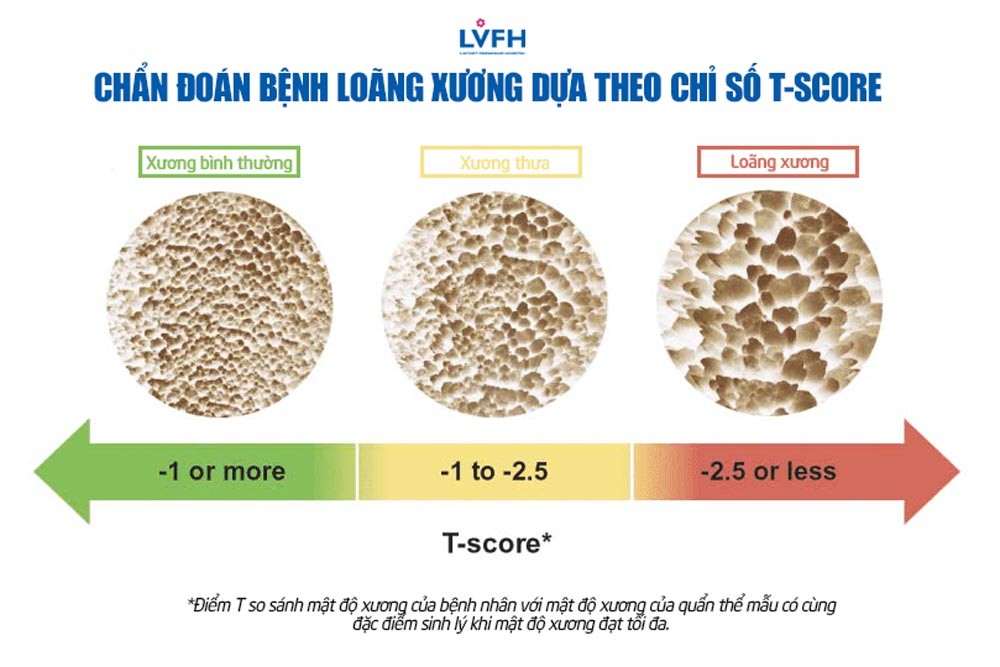 Chẩn đoán loãng xương dựa theo chỉ số T-Score