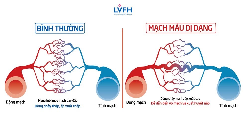 Gia tăng tỷ lệ đột quỵ ở người trẻ do dị dạng mạch máu não bẩm sinh