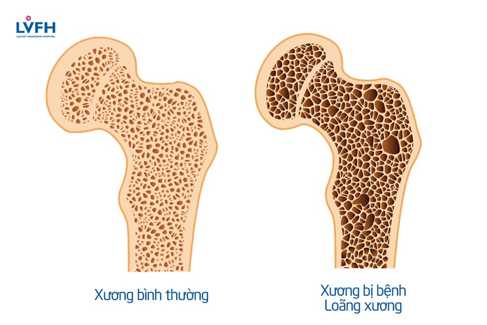 Loãng xương là tình trạng xương liên tục mỏng dần, mật độ xương giảm theo thời gian, làm cho xương giòn hơn, dễ bị tổn thương