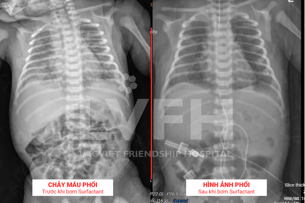 Hình ảnh phim chụp X-quang của bé P. trước và sau khi bơm Surfactant