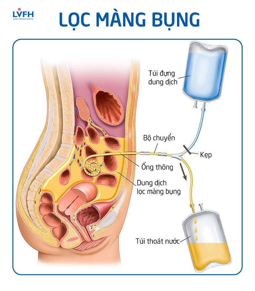 Lọc màng bụng có thể thực hiện tại nhà, phù hợp với bệnh nhân vùng sâu, vùng xa