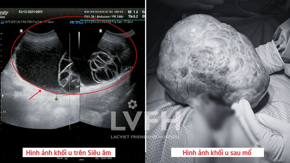 Bóc tách thành công khối u buồng trứng ác tính khổng lồ cho bệnh nhân cao tuổi, nhiều bệnh nền