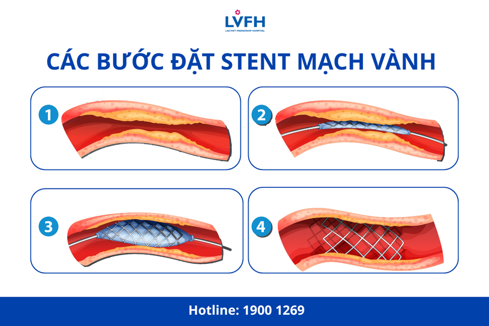 cac buoc dat stent mach vanh