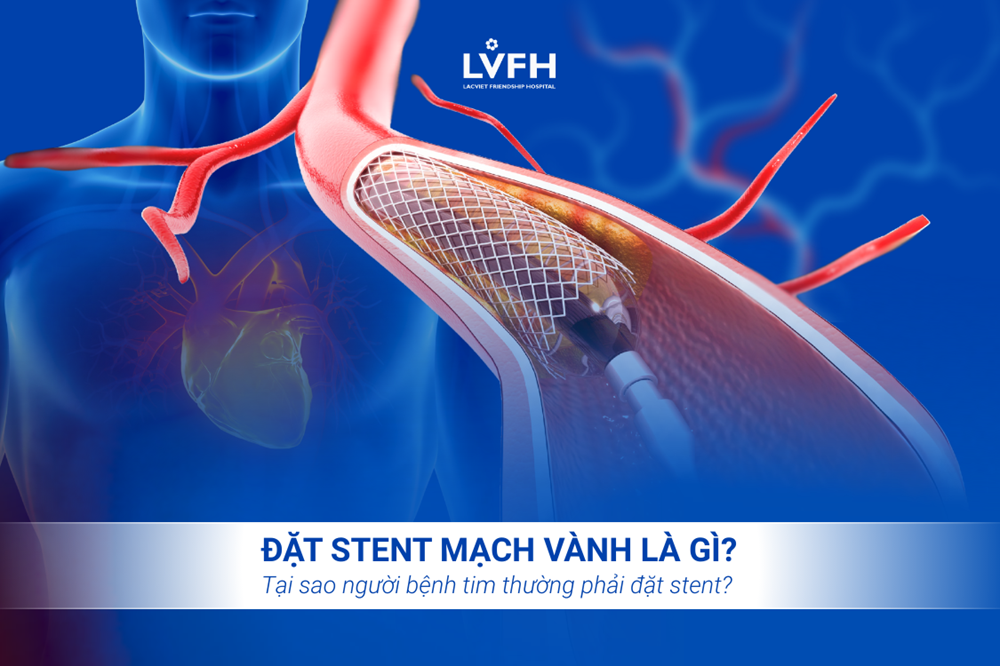 Đặt Stent mạch vành là gì? Tại sao người bệnh tim thường phải đặt stent?