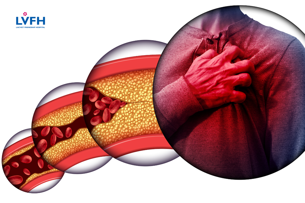 Đặt stent mạch vành thường được thực hiện để điều trị các bệnh mạch vành hoặc xử trí trường hợp nhồi máu cơ tim cấp hay các vấn đề liên quan đến mạch máu.