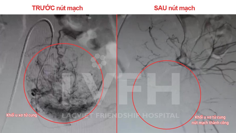 Hình ảnh trước và sau nút mạch u xơ tử cung của bệnh nhân L.