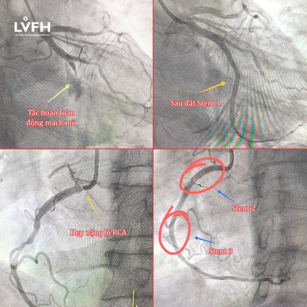 Chụp mạch vành và đặt 3 stent cho bệnh nhân S. bị nhồi máu cơ tim cấp