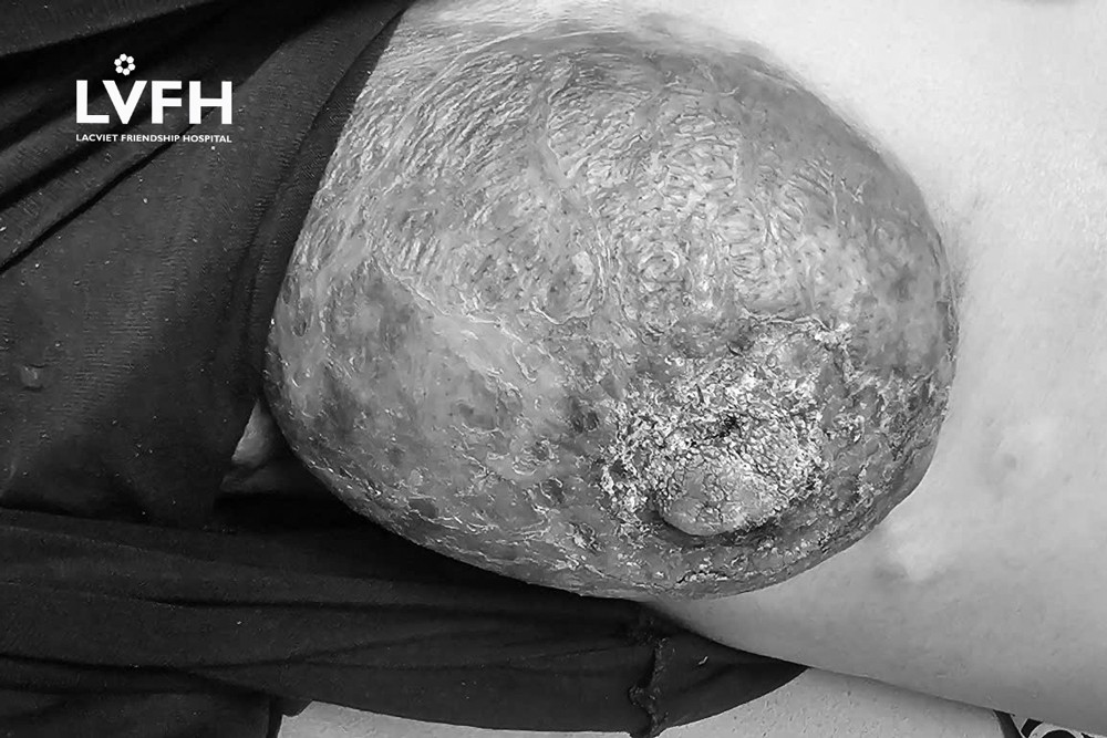 Tiền mất tật mang vì điều trị ung thư bằng thuốc nam