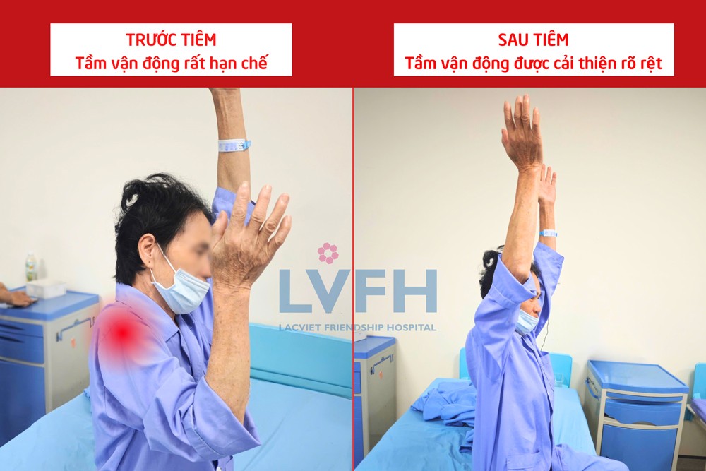 Điều trị đông cứng khớp vai an toàn, hiệu quả bằng tiêm nong dưới hướng dẫn siêu âm
