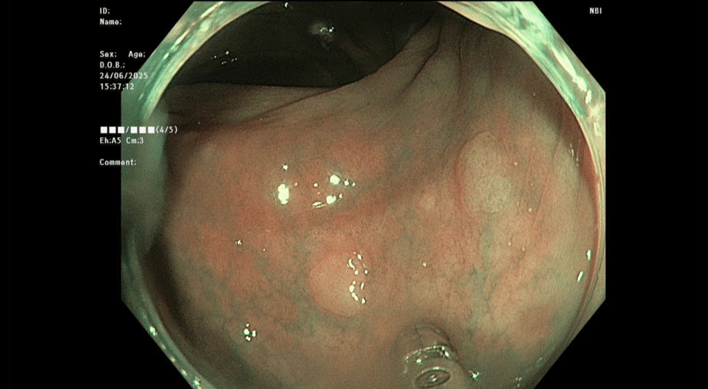 Hinh anh Polyp dai trang BN Dat 1024x563 1