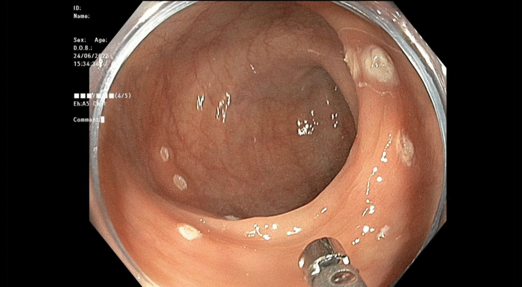 Polyp dai trang da cat BN Dat 1024x563 1