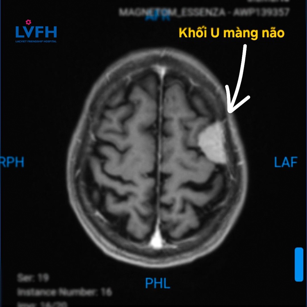 Khối u não của bệnh nhân L. 72 tuổi trên hình ảnh chụp Cộng hưởng từ.
