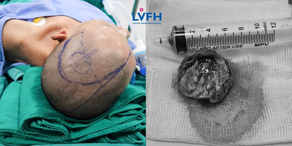 Thành công mổ u não cho cho cụ ông 72 tuổi có tiền sử ung thư phổi suốt 10 năm