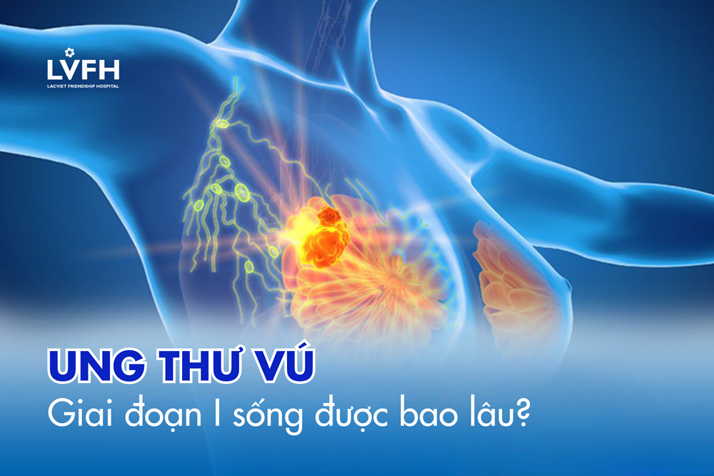 Ung thư vú giai đoạn 1 sống được bao lâu? Tiên lượng và cách kéo dài tuổi thọ