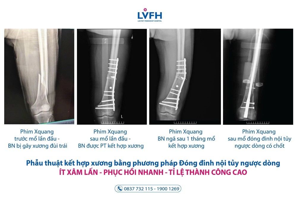 Hai lần gãy xương đùi trong một tháng – Bệnh nhân được mổ kết hợp xương bằng phương pháp ưu việt