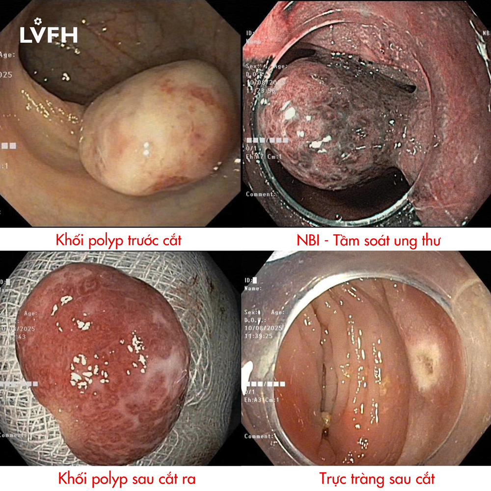 Nội soi trực tràng phát hiện khối polyp khủng cho bệnh nhi 4 tuổi 1 polyp khung tre 4 tuoi
