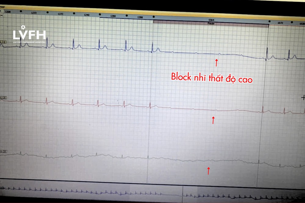 33 tuổi, hay choáng đầu, bất ngờ phát hiện do rối loạn nhịp tim nguy hiểm