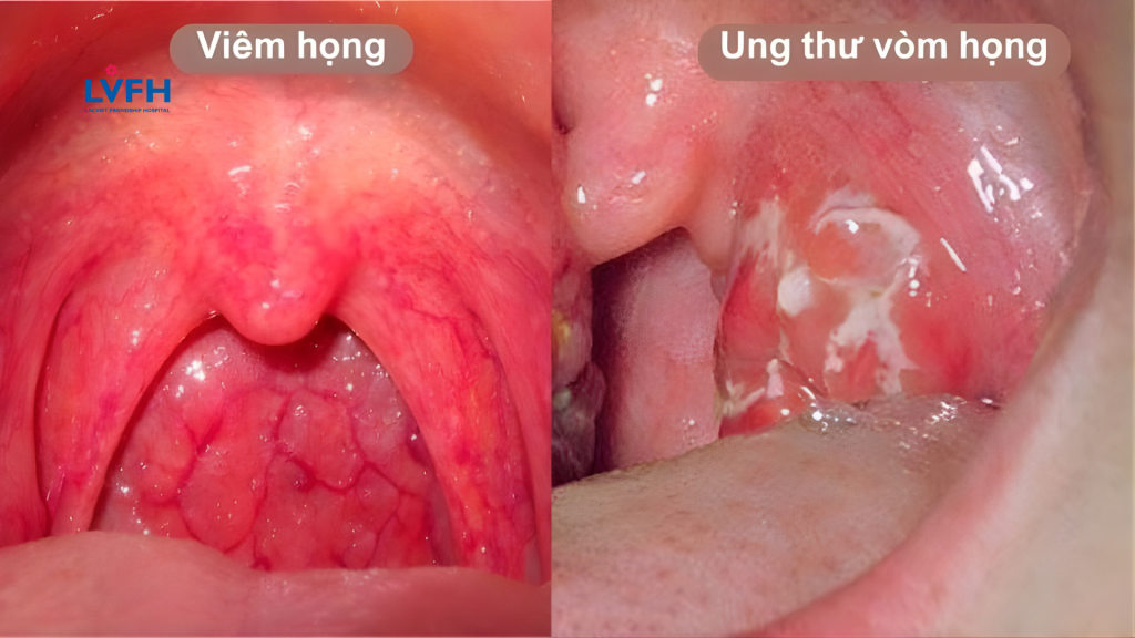 Ung thư vòm họng: Nguyên nhân, dấu hiệu và phương pháp điều trị hiệu quả