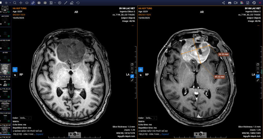 Phát hiện u não bằng MRI 3.0 Tesla: Gần 50% ca bệnh được phát hiện tình cờ tại Bệnh viện Lạc Việt