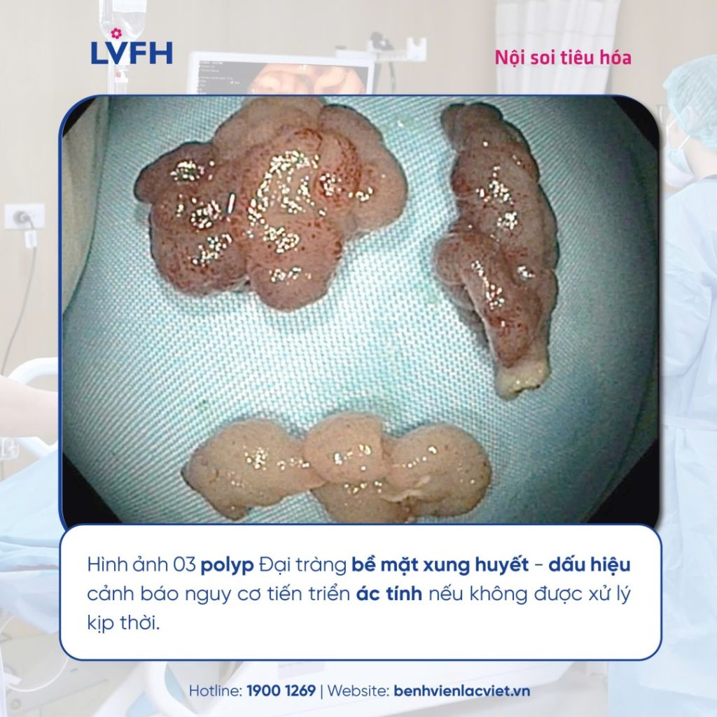 Phát hiện và loại bỏ nhanh 3 polyp đại tràng kích thước lớn