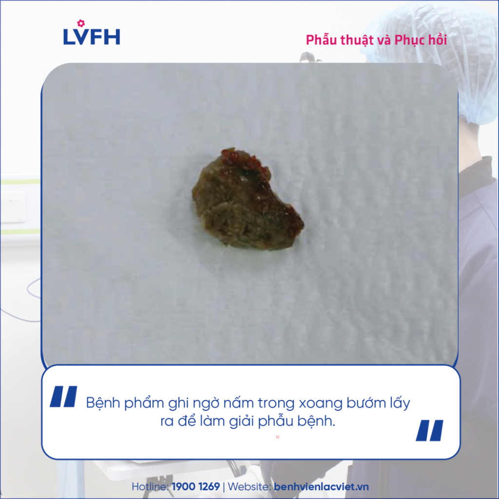 Viêm xoang bướm – căn bệnh âm thầm nhưng tiềm ẩn nhiều biến chứng nguy hiểm