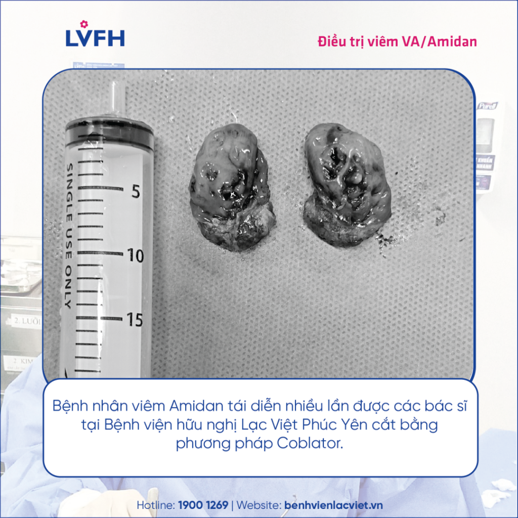 ĐIỀU TRỊ VIÊM VA/VIÊM AMIDAN BẰNG COBLATOR TẠI LẠC VIỆT: NHẸ NHÀNG – ÍT CHẢY MÁU – PHỤC HỒI NHANH
