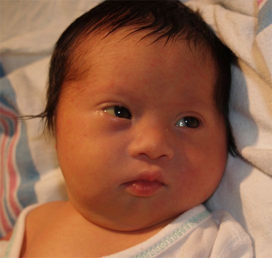Hội chứng Down Trisomy 21