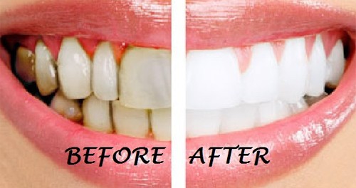 10 cách làm trắng răng tự nhiên bạn cần biết