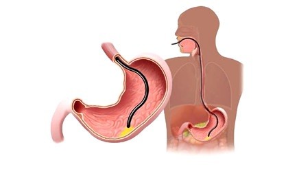 Nội soi dạ dày, đại tràng gây mê