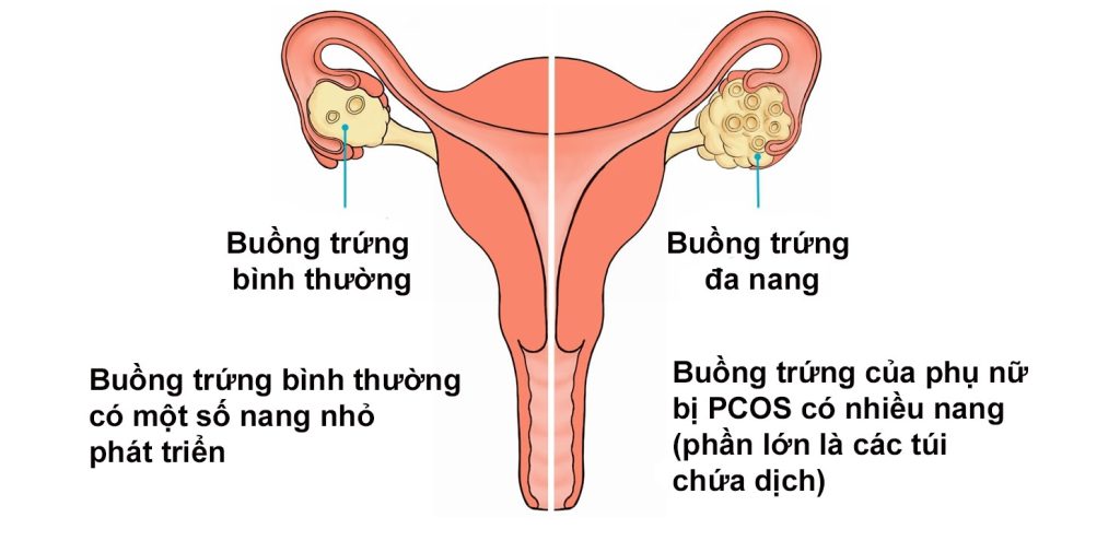 Phương pháp chẩn đoán buồng trứng đa nang