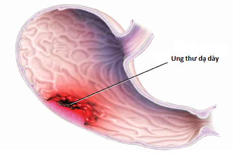 Tầm soát ung thư dạ dày