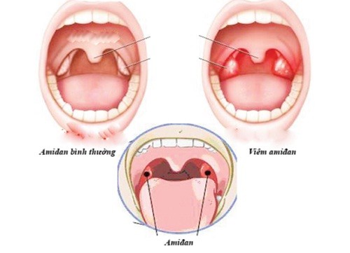 Tìm hiểu về viêm amidan và phương pháp điều trị viêm amidan