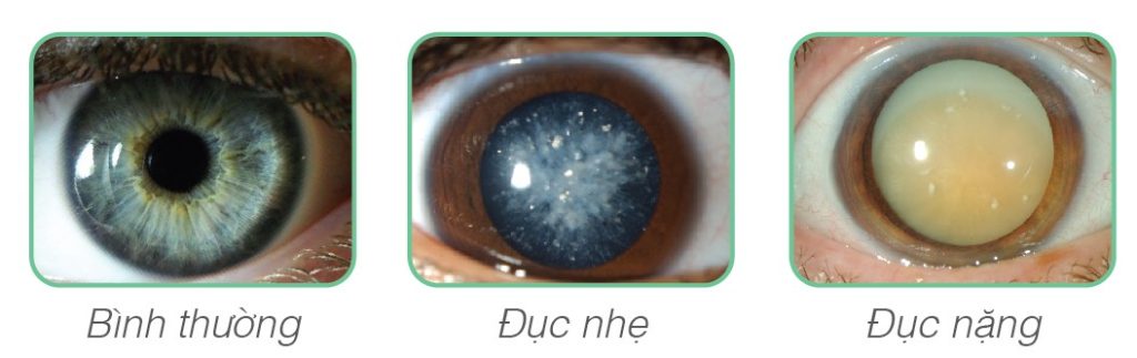 Dấu hiệu đục thủy tinh thể