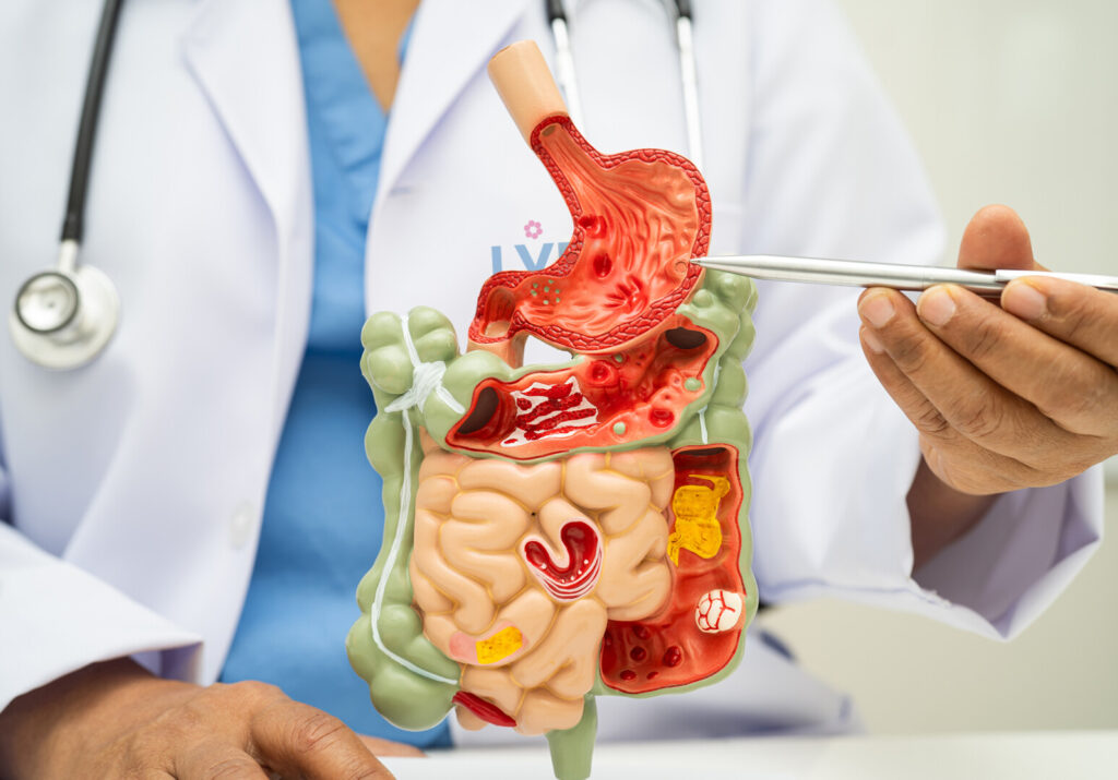 POLYP ĐẠI TRÀNG – NHỎ NHƯNG KHÔNG “VÔ HẠI”